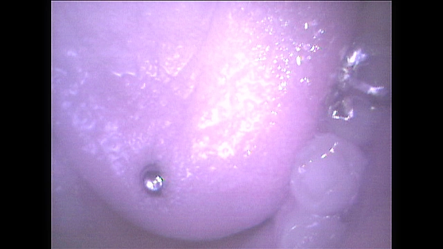 歯16