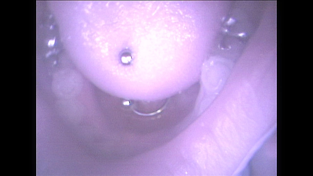 歯16