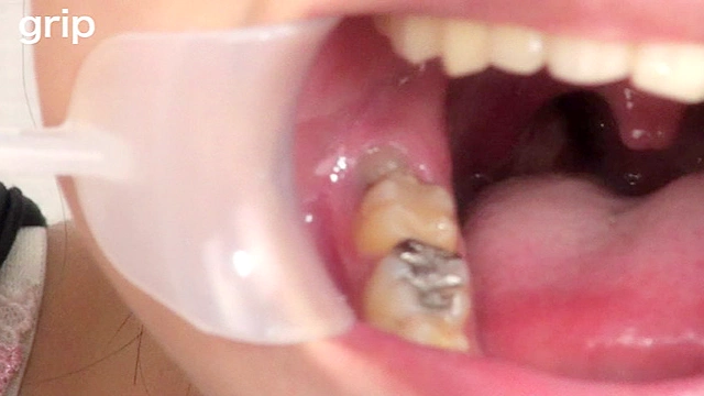 口腔咀嚼診察 粘膜剥き出し！！開口器美女 高沢沙耶