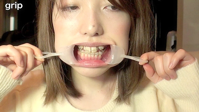 素人歯列矯正 顔面デストロイ 矯正中のリョウコちゃん
