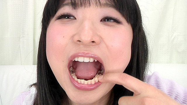 銀歯インレーフェチ 咲希ちゃんの口内には銀歯がいっぱい！