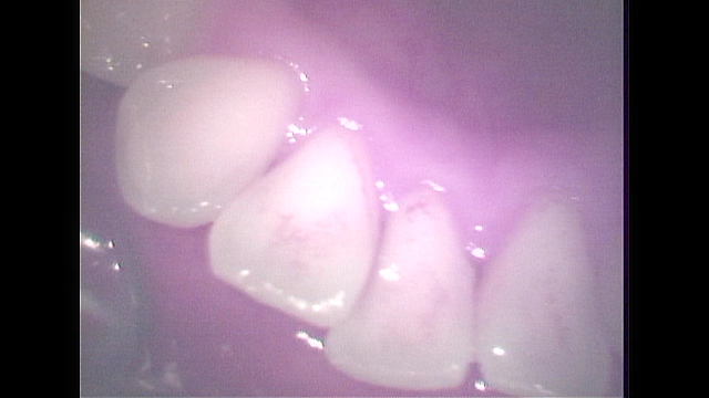 歯05