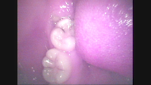 歯05