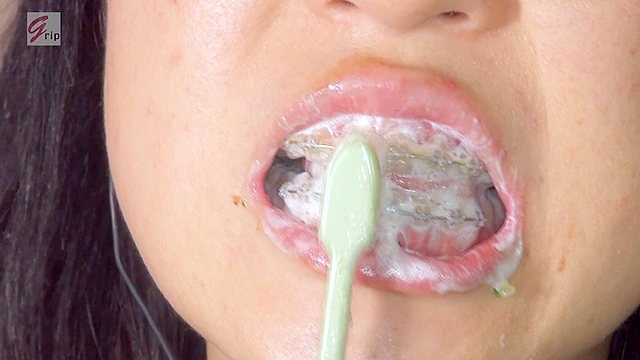 30代から始めた矯正を徹底鑑賞！歯列矯正中の熟女