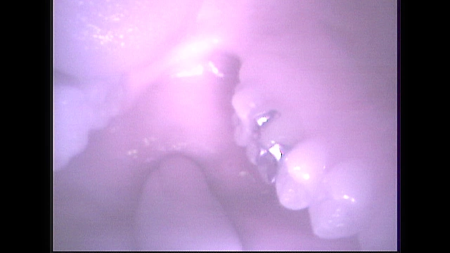 歯19