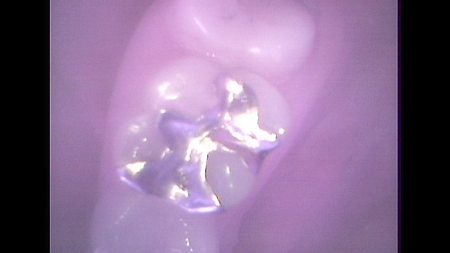 歯19