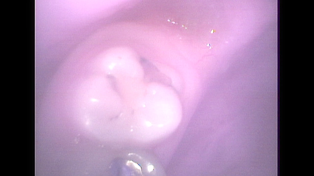 歯19