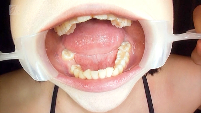 歯が1本ない親知らずあり口腔◎唾液スコールと口臭の風に吹かれて