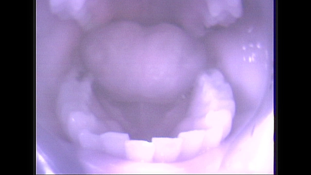 歯03